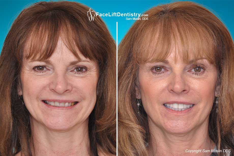 facelift-dentistry-overbite-correction.jpg