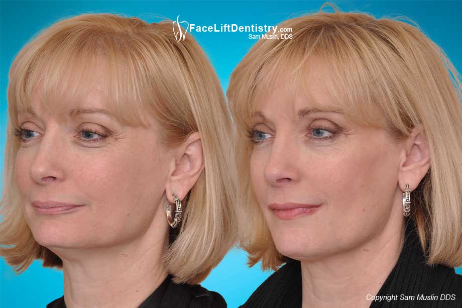 patient showing the impact of facial aging reversed with anti-aging face lift dentistry