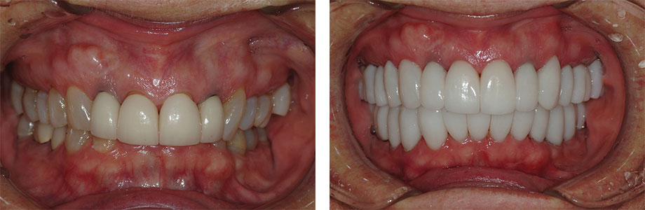 Neuromuscular Dentistry Vs. Jawtrac Jaw Positioning