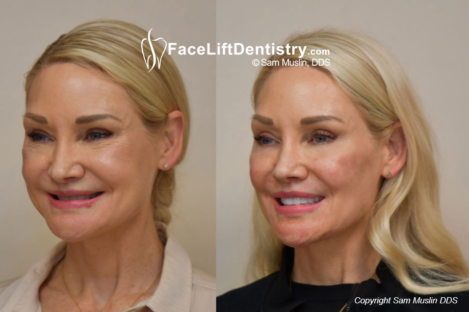 Face Lift Dentistry Jaw and Bite Correction - Before and After