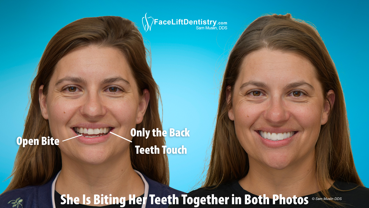 Before and After VENLAY® Open Bite Correction