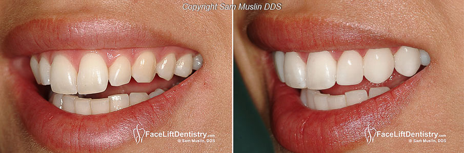 correcting-long-or-large-looking-front-teeth