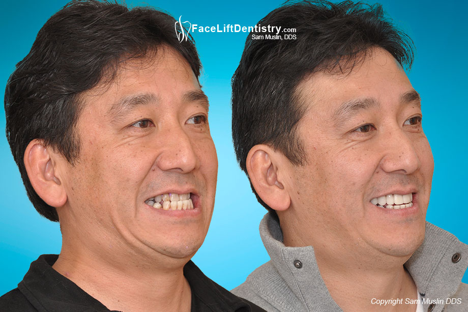 Patient with his lower jaw moved back without surgery to correct an underbite