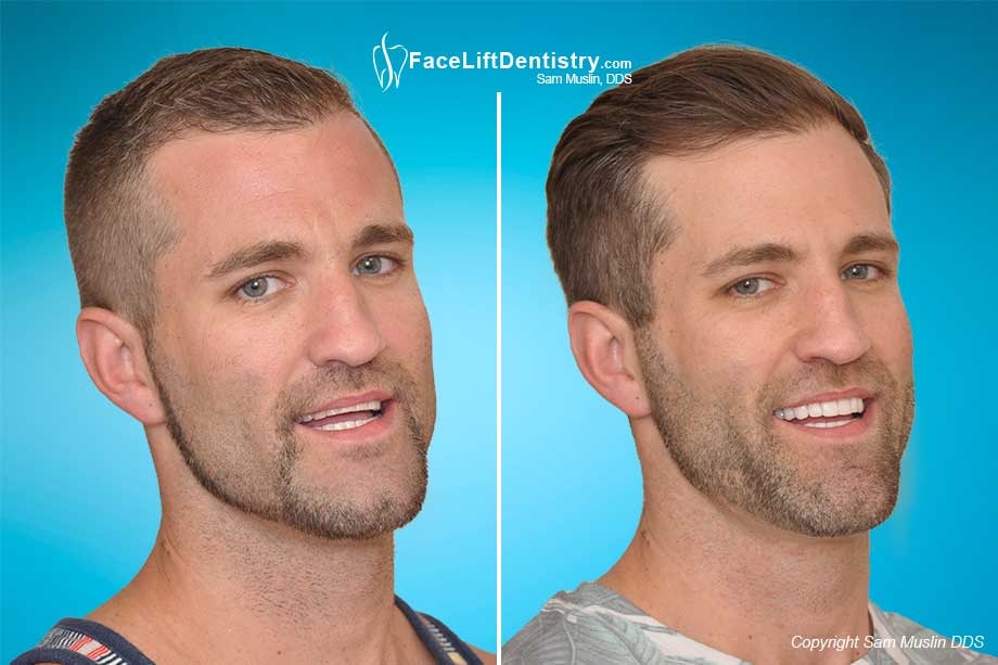 Misaligned Jaw Facial Changes 
