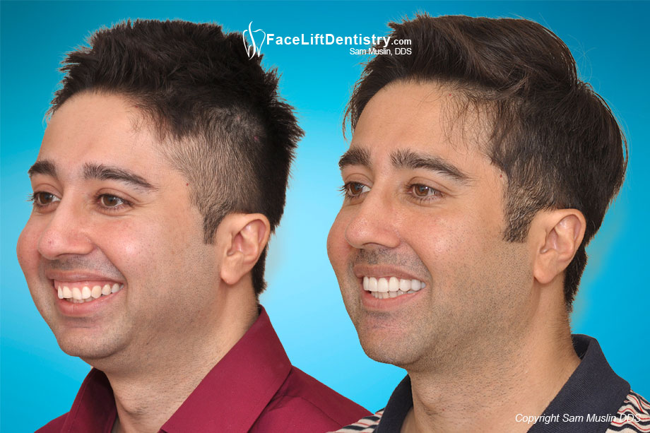 Crooked jaw, small chin, and overbite corrected - Before and After