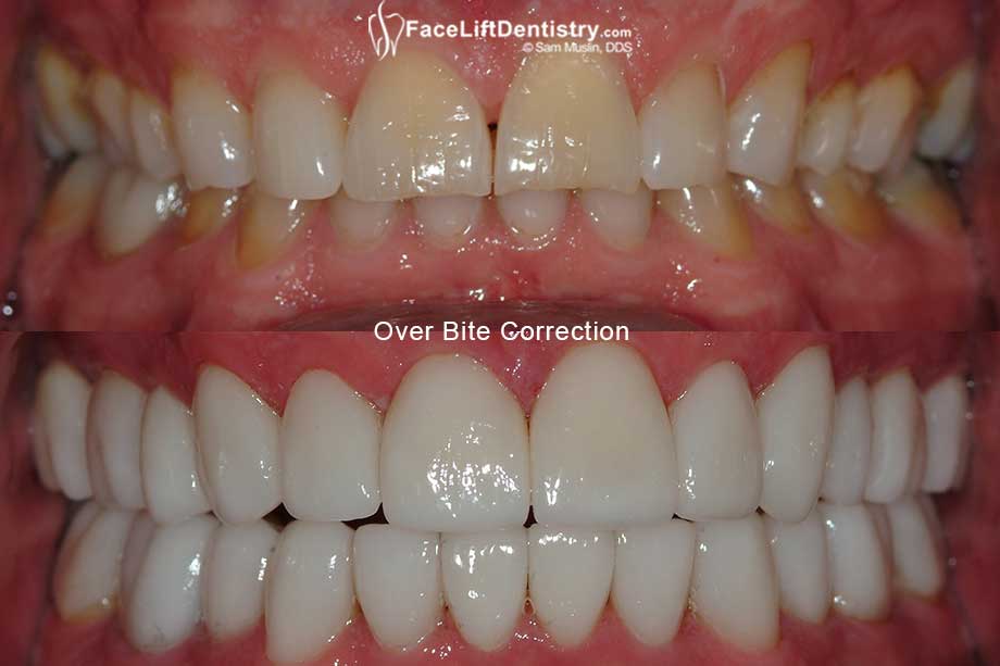 Over Bite Fix Without Braces in 8-Days