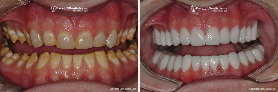 Before and After Amelogenesis Imperfecta treated and bad bite corrected.