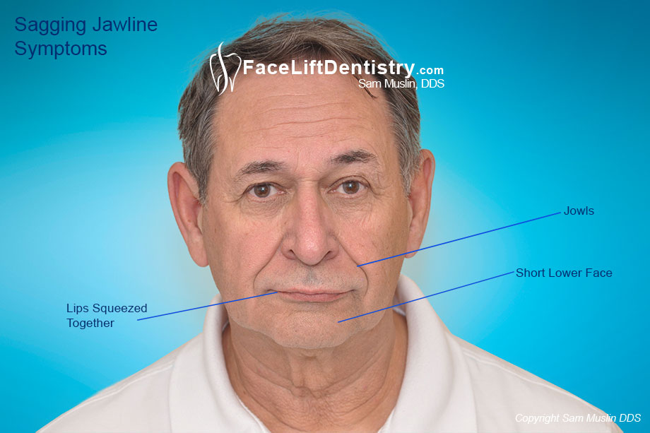 A photo showing the signs of aging on the face of a middle-aged man. A misaligned jaw and worn teeth impacts his face resulting in an older grumpy look.