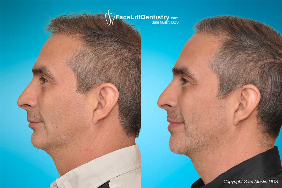 Receded Mandible and Overbite Fix without Surgery or Drilling Down Teeth
