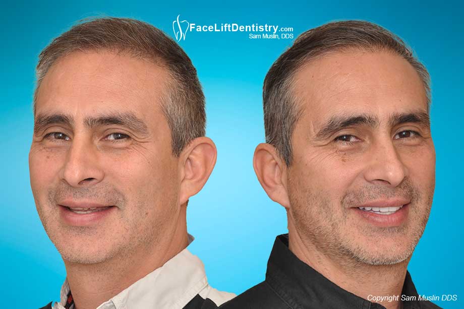 Anti-Aging Face Lift Dentistry