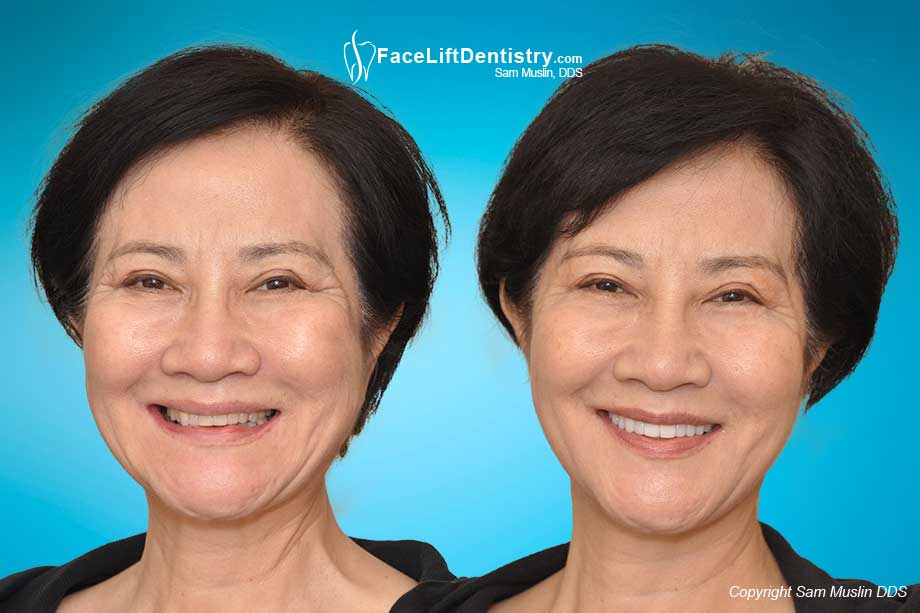 Before and after VENLAY® Restorations were used to correct the collapsed bite.