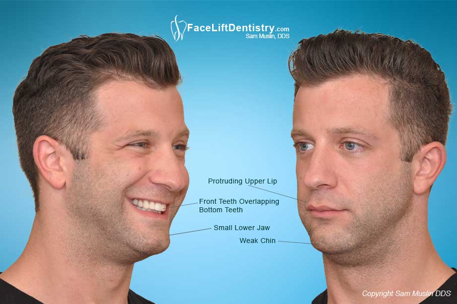 Characteristics of a weak or receding chin