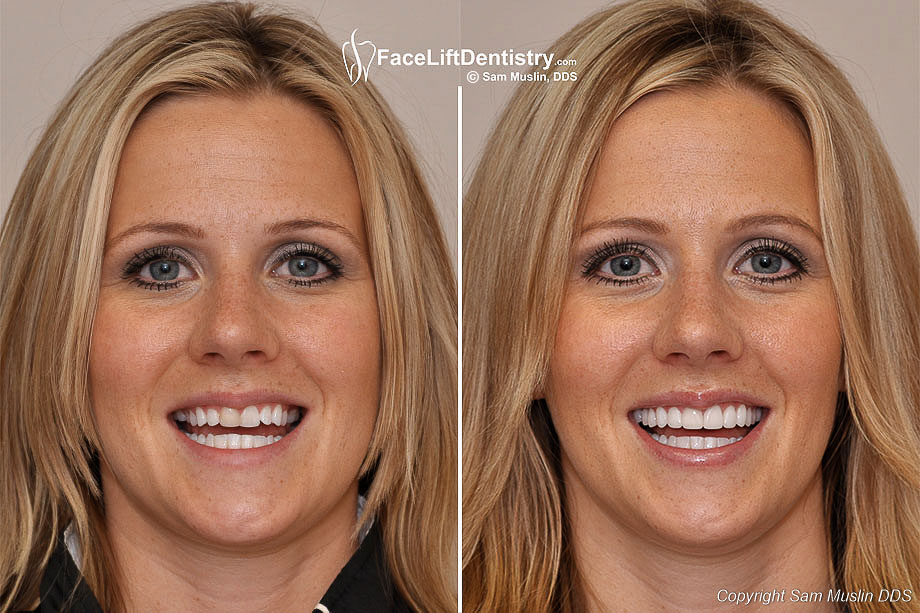 Wider Smiles With No Drilling Veneers