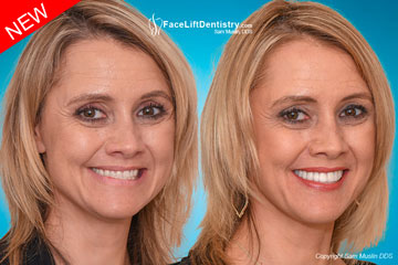 Pseudo-Class III Malocclusion with Crossbite Fixed in 8-Days - Before and After Photo Pseudo-Class III Malocclusion with Crossbite Fixed in 8-Days - Before and After Photo