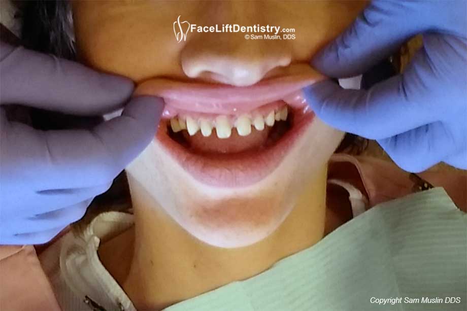 veneers teeth bad before down cosmetic conservative porcelain drill worst why dentist tooth drilling overbite bite dentistry open faceliftdentistry