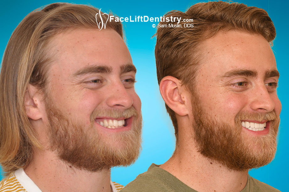 Clicking and Lockjaw Problems - Before and After Photo Clicking and Lockjaw Problems - Before and After Photo