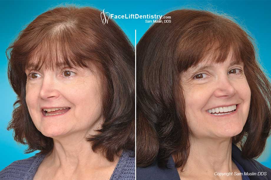 Facial Collapse Reversed with Non-Invasive Anti-Aging Dentistry - Before and After Photo Facial Collapse Reversed with Non-Invasive Anti-Aging Dentistry - Before and After Photo
