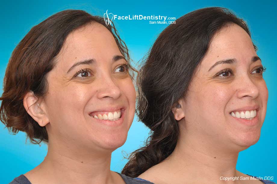 Speech Clarity and the Optimal Jaw Position - Before and After Photo Speech Clarity and the Optimal Jaw Position - Before and After Photo