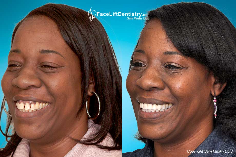 Buck Teeth Corrected - No Braces or Jaw Surgery. - Before and After Photo Buck Teeth Corrected - No Braces or Jaw Surgery. - Before and After Photo