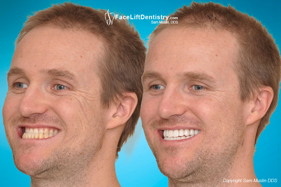 Underbite Quick Fix - Before and After Photo Underbite Quick Fix - Before and After Photo