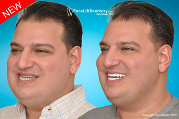 Underbite Crooked Jaw Surgery Avoided - Before and After Photo Underbite Crooked Jaw Surgery Avoided - Before and After Photo