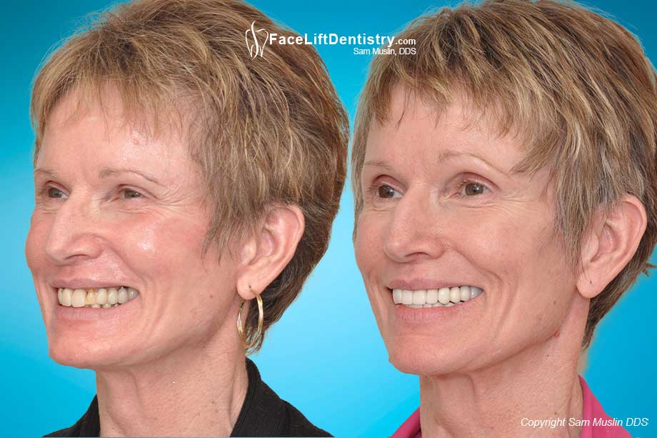 Facial Collapse Reversed - Before and After Photo Facial Collapse Reversed - Before and After Photo