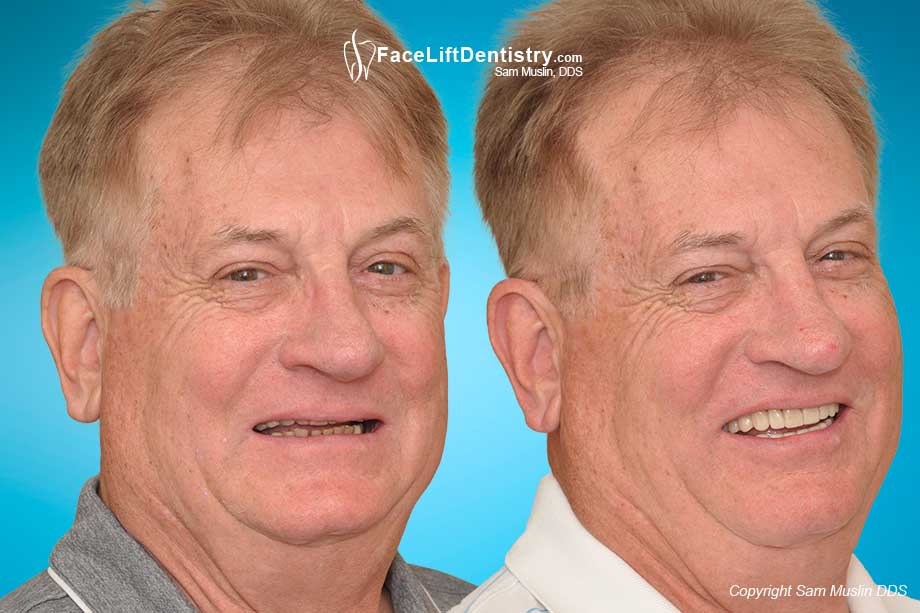 Restoring Aging Teeth with VENLAY® Restorations - Before and After Photo Restoring Aging Teeth with VENLAY® Restorations - Before and After Photo