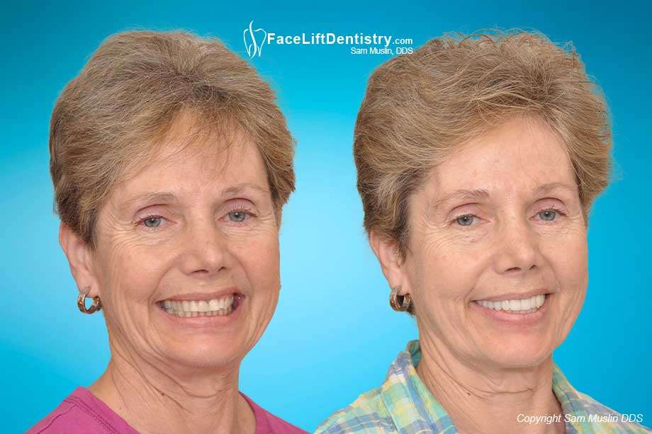 Treating Jaw Clicking and Popping - Before and After Photo Treating Jaw Clicking and Popping - Before and After Photo