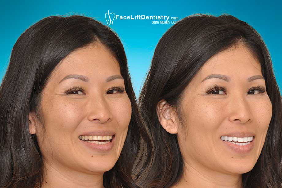 Treatment for TMJ and TMD Clenching and Grinding - Before and After Photo Treatment for TMJ and TMD Clenching and Grinding - Before and After Photo
