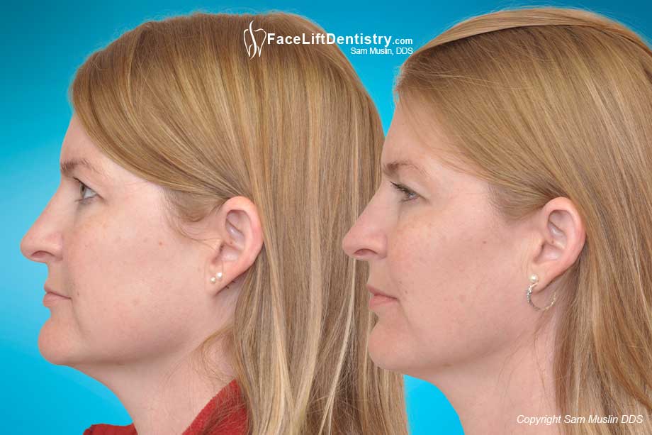 Small Teeth and Posterior Bite Collapse - Before and After Photo Small Teeth and Posterior Bite Collapse - Before and After Photo