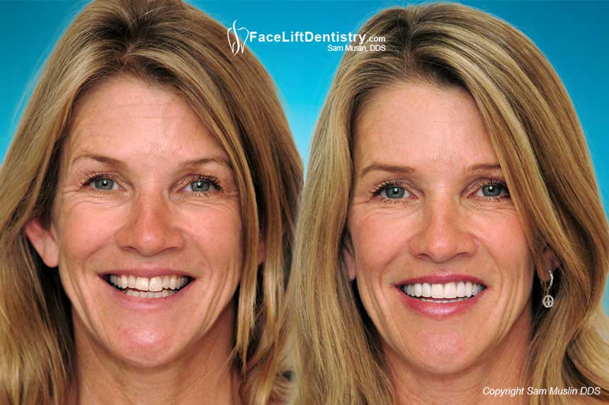 Porcelain Veneers and Cosmetic Dentistry - Before and After Photo Porcelain Veneers and Cosmetic Dentistry - Before and After Photo