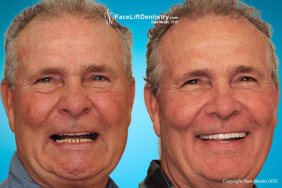 Bad Bite, Old Crowns, Can't See Upper Teeth - Before and After Photo Bad Bite, Old Crowns, Can't See Upper Teeth - Before and After Photo