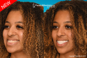 Underbite JawTrac Jaw Position - Before and After Photo Underbite JawTrac Jaw Position - Before and After Photo