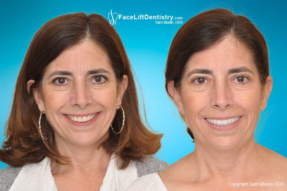 Jaw Stress and Neck Pain - Before and After Photo Jaw Stress and Neck Pain - Before and After Photo