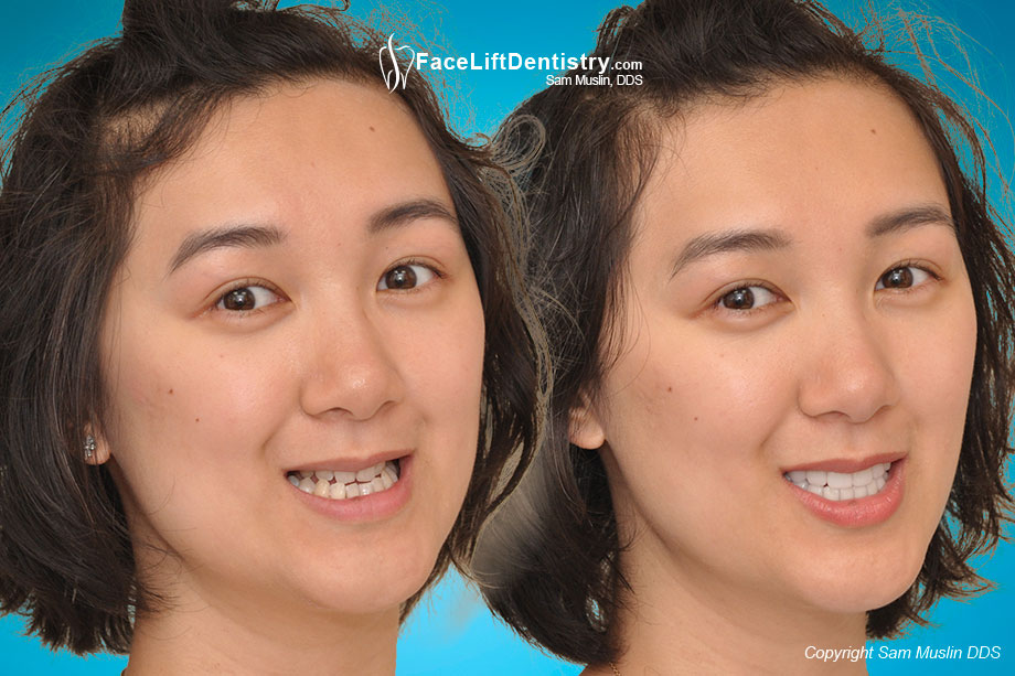 What Happens If You Have No Back Teeth? - Before and After Photo What Happens If You Have No Back Teeth? - Before and After Photo