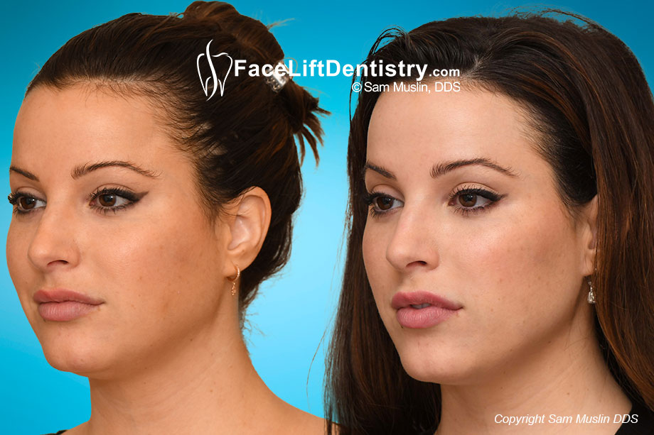 Face Lift Dentistry and Neuromuscular TMJ Treatment Compared Face Lift Dentistry and Neuromuscular TMJ Treatment Compared