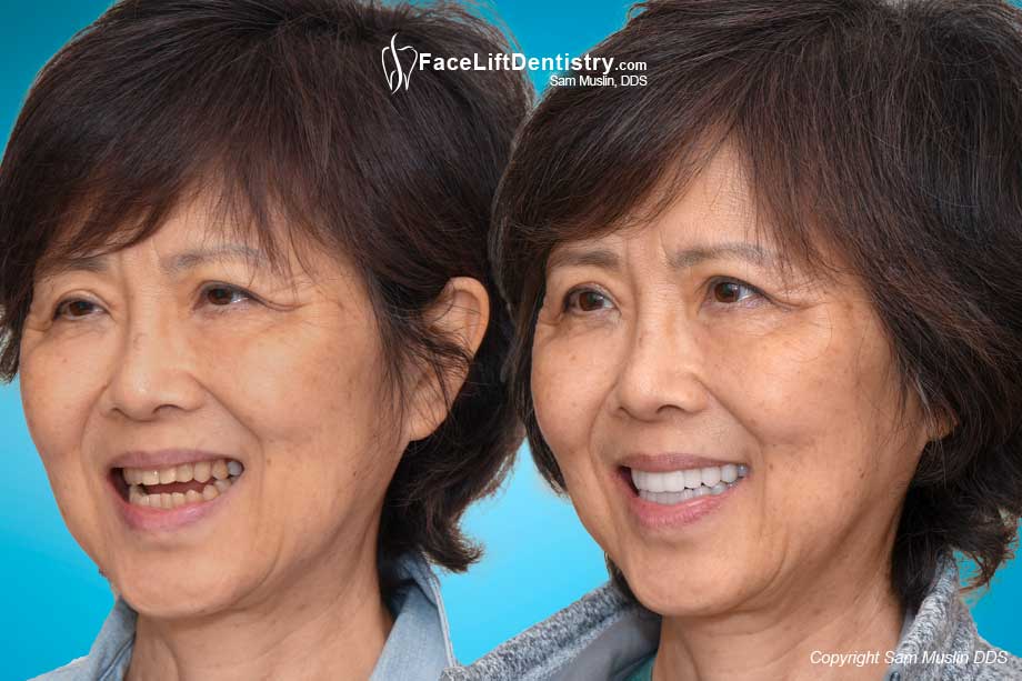 TMD Pain and Anterior Open Bite Fixed, No Surgery - Before and After Photo TMD Pain and Anterior Open Bite Fixed, No Surgery - Before and After Photo