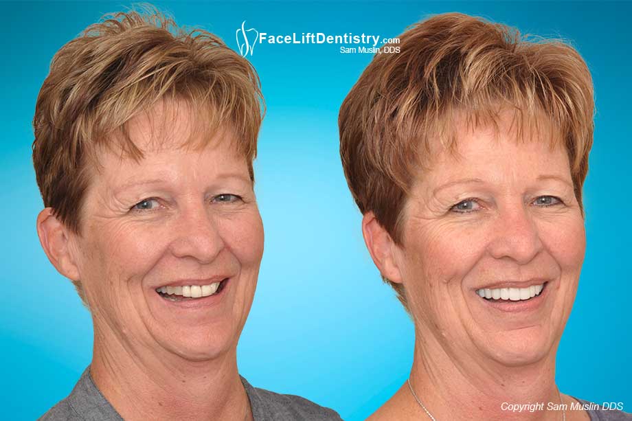 Neuromuscular Dentistry vs. JawTrac Jaw Positioning - Before and After Photo Neuromuscular Dentistry vs. JawTrac Jaw Positioning - Before and After Photo