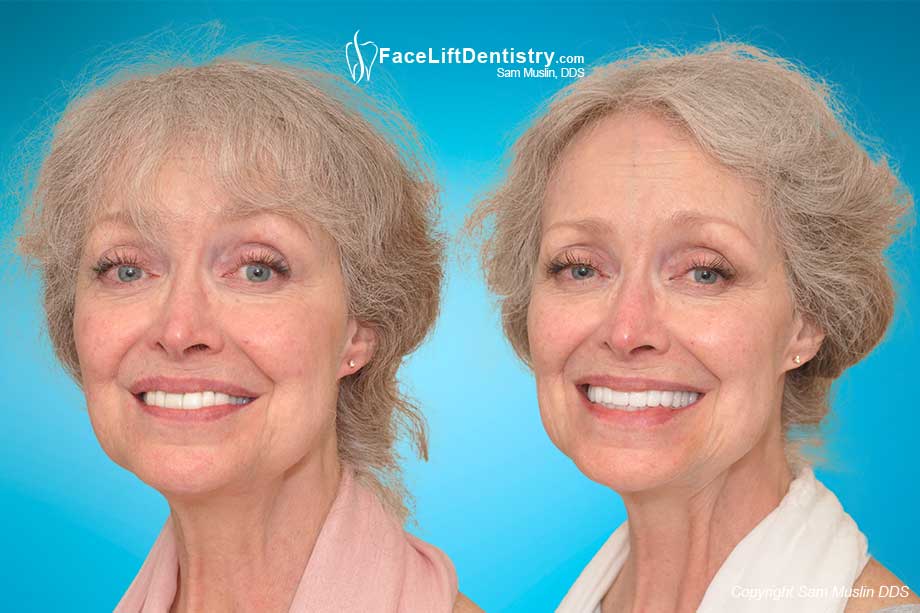 Tooth Shaving and Veneers can Destroy your Bite - Before and After Photo Tooth Shaving and Veneers can Destroy your Bite - Before and After Photo