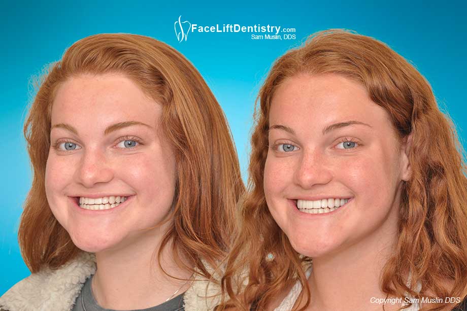 Underbite Protruding Chin - Before and After Photo Underbite Protruding Chin - Before and After Photo