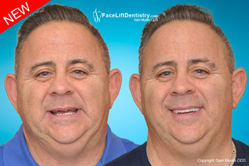 How to Rebuild Worn Teeth and Realign the Bite in 8-Days - Before and After Photo How to Rebuild Worn Teeth and Realign the Bite in 8-Days - Before and After Photo