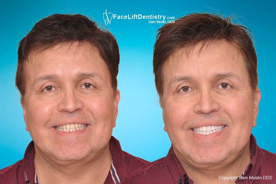 Failed Jaw Surgery Non-Surgical Correction - Before and After Photo Failed Jaw Surgery Non-Surgical Correction - Before and After Photo