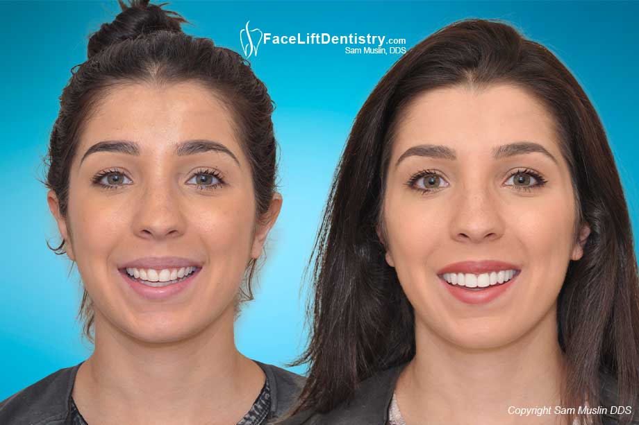 Facelift Dentistry Before and After Photos