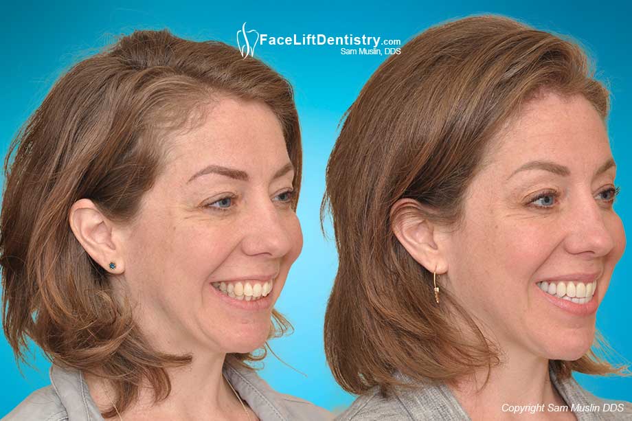 Overbite Jaw Position and Tension - Before and After Photo Overbite Jaw Position and Tension - Before and After Photo