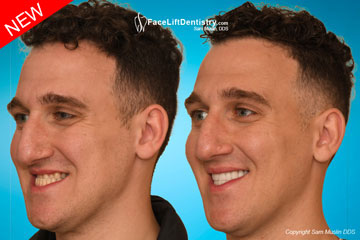 Underbite Crossbite Fix - Before and After Photo Underbite Crossbite Fix - Before and After Photo