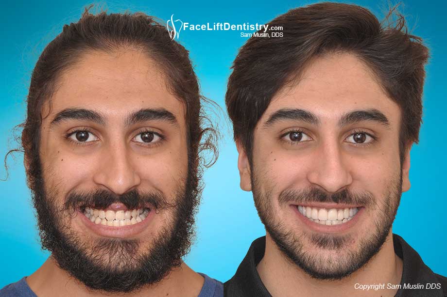 jaw surgery underbite before correction overbite alignment chin alternative bite social guy braces without under perceptions muslin sam open cosmetic