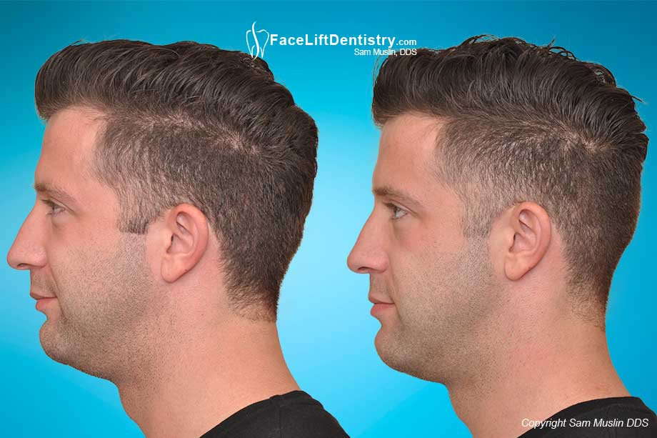 Weak chin and jaw corrected without surgery, resulting in less jaw tension and a boosted self-confidence.